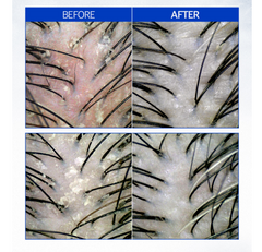 F:B HYPER DEEP CLEANING SCALP SCALER