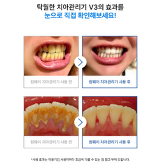 OneWay Oral Irrigator